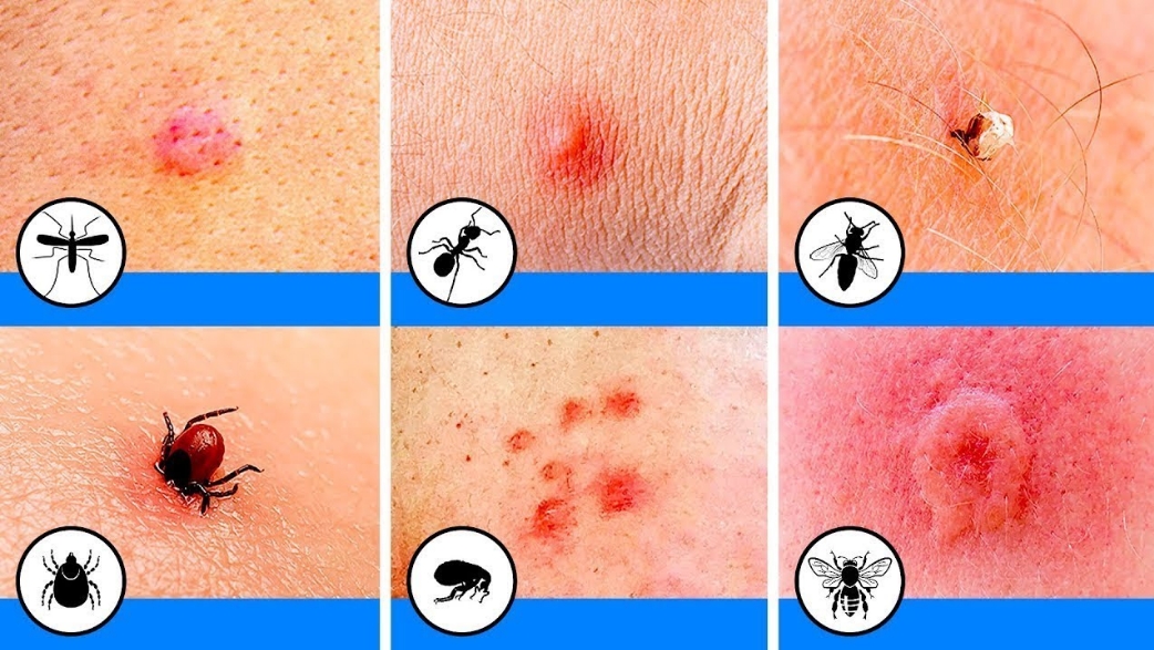 12 Insektenstiche, die jeder erkennen und identifizieren können sollte